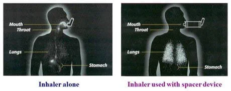 An image showing the difference between using using an inhaler without a spacer and using one with.