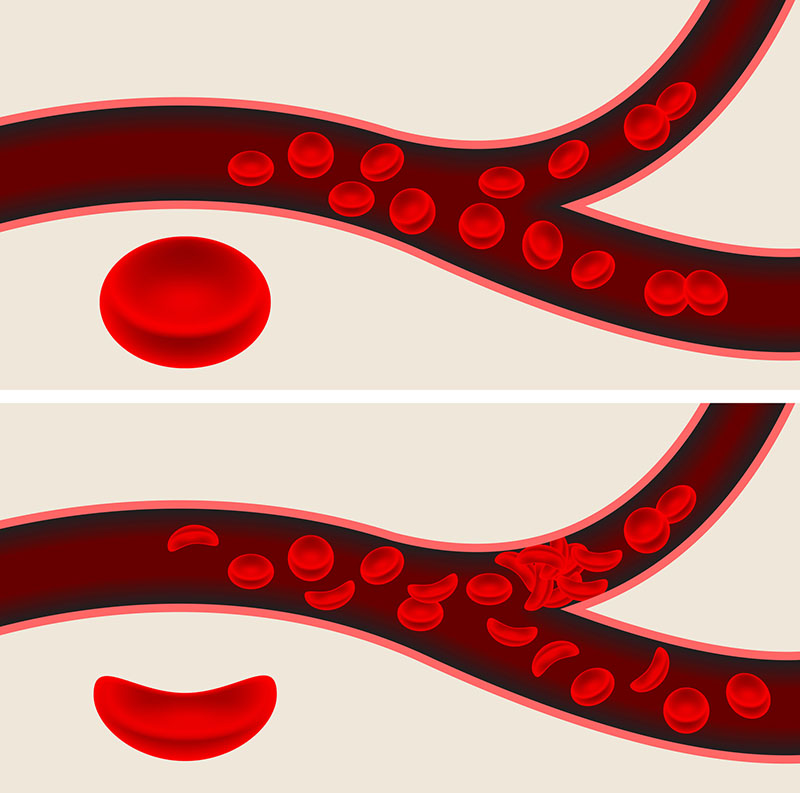An illustration of how normal blood cells versus sickle-shaped blood cells flow through blood vessels. The split image shows how normal blood cells flow freely through blood vessels and how sickle-shaped blood cells get stuck and do not flow freely.