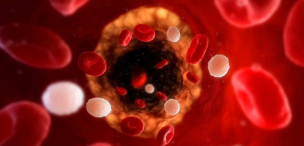 a digital image of red blood cells moving through an artery that build-up along the artery walls.